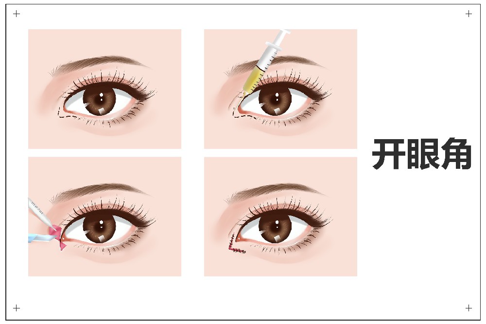 內外眼角開(kāi)大術(shù)